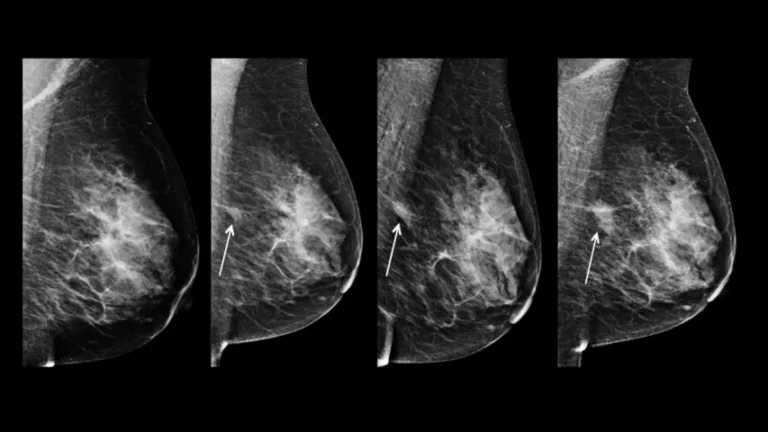 Breast cancer images mammogram