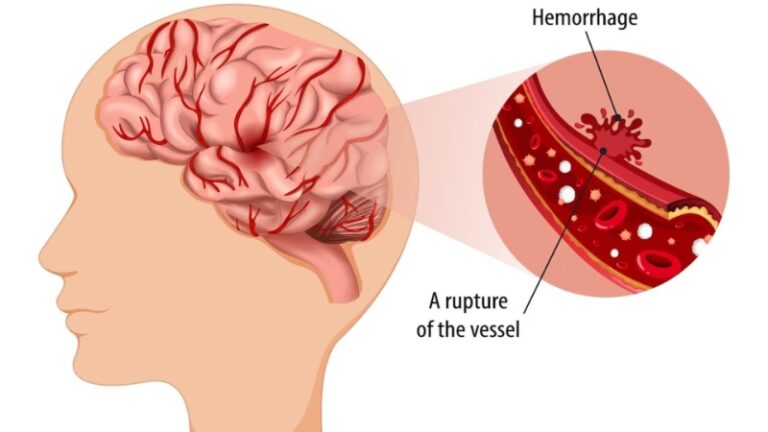 What is a hemorrhagic stroke